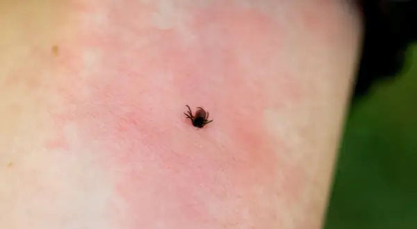 Jak wygląda kleszcz na ciele? Zobacz, jak go rozpoznać i usunąć