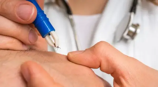 Jak wyjmować kleszcze - skuteczne metody, które zmniejszają ryzyko zakażenia